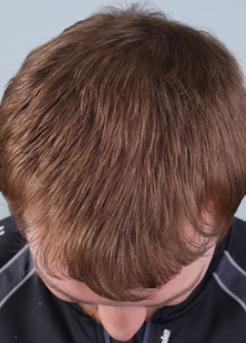 After Hair Transplant&nbsp;Hairlines